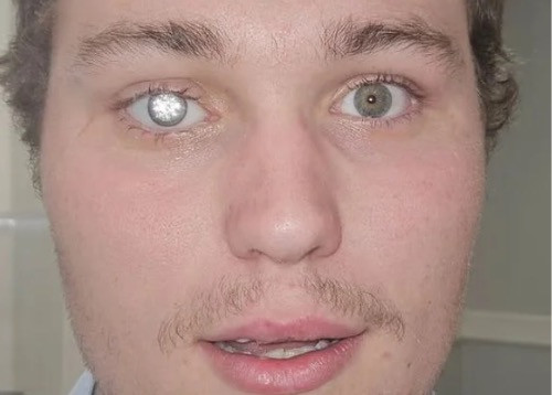 Jeweller gets $2m prosthetic eye fitted with two-carat diamond as eyeball